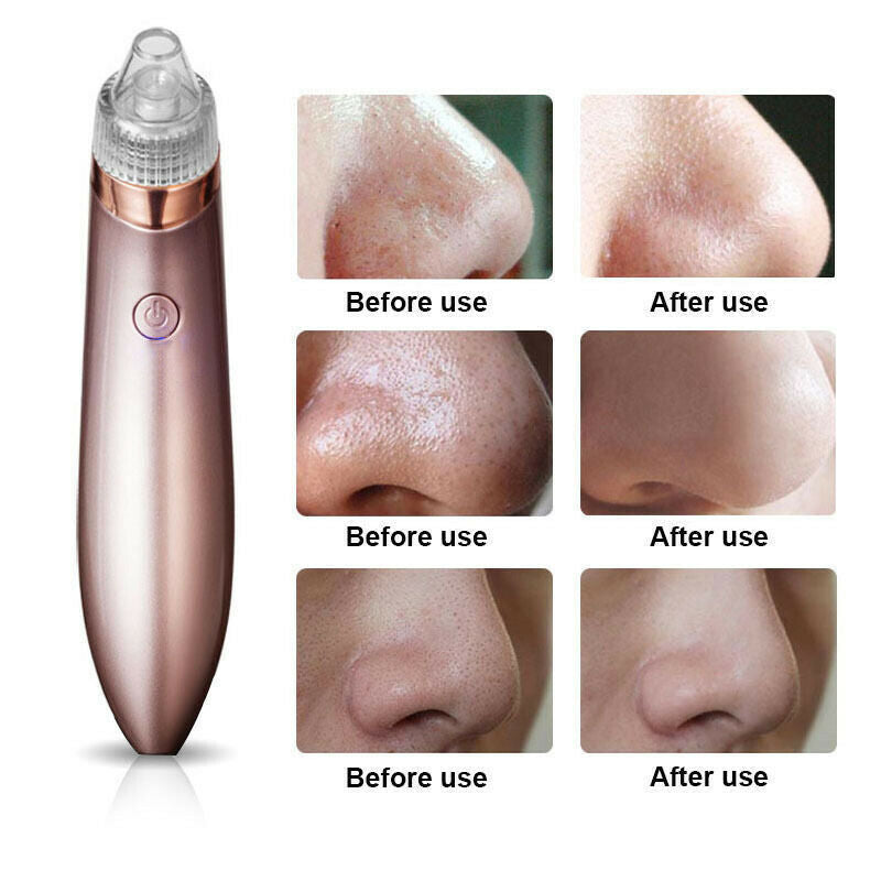 Electric Blackhead Remover Vacuum – Deep Pore Cleaner & Acne Suction Tool for Flawless Skin